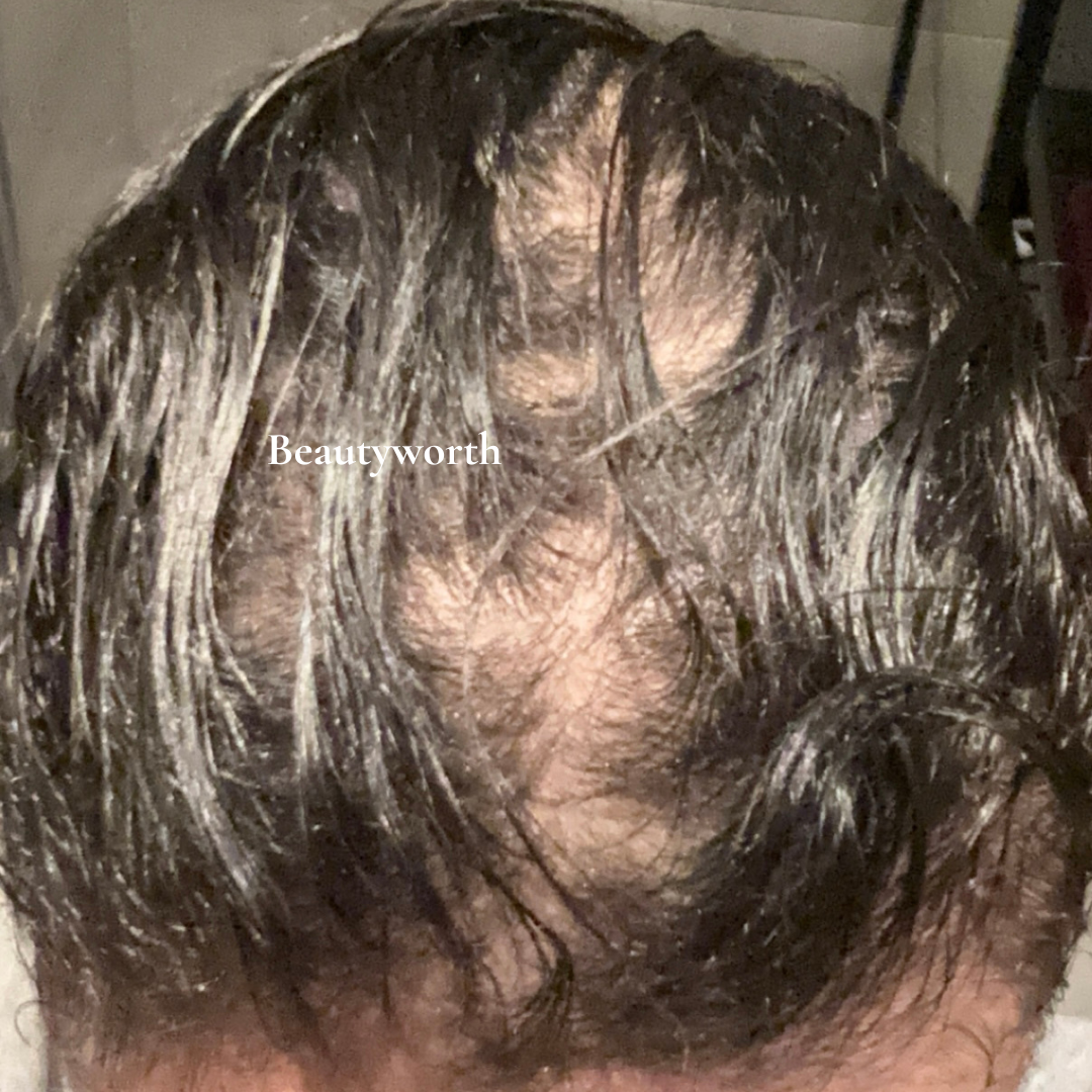 Natuurlijke haarolie voor haarverlies verminderen